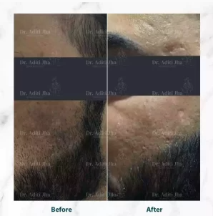 Before and after dermatology treatment result