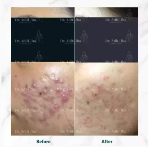 Before and after dermatology treatment result