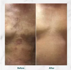 Before and after dermatology treatment result