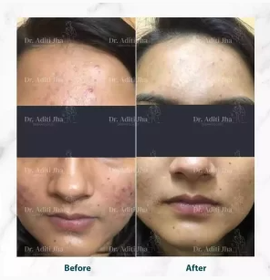 Before and after dermatology treatment result