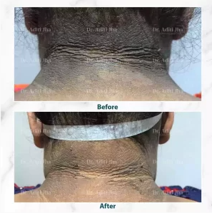 Before and after dermatology treatment result