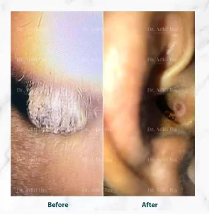 Before and after dermatology treatment result