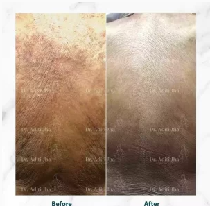 Before and after dermatology treatment result