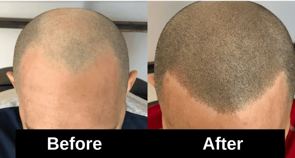 hair to hair micropigmentation