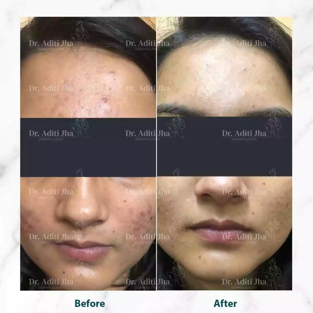 Acne (front face)
