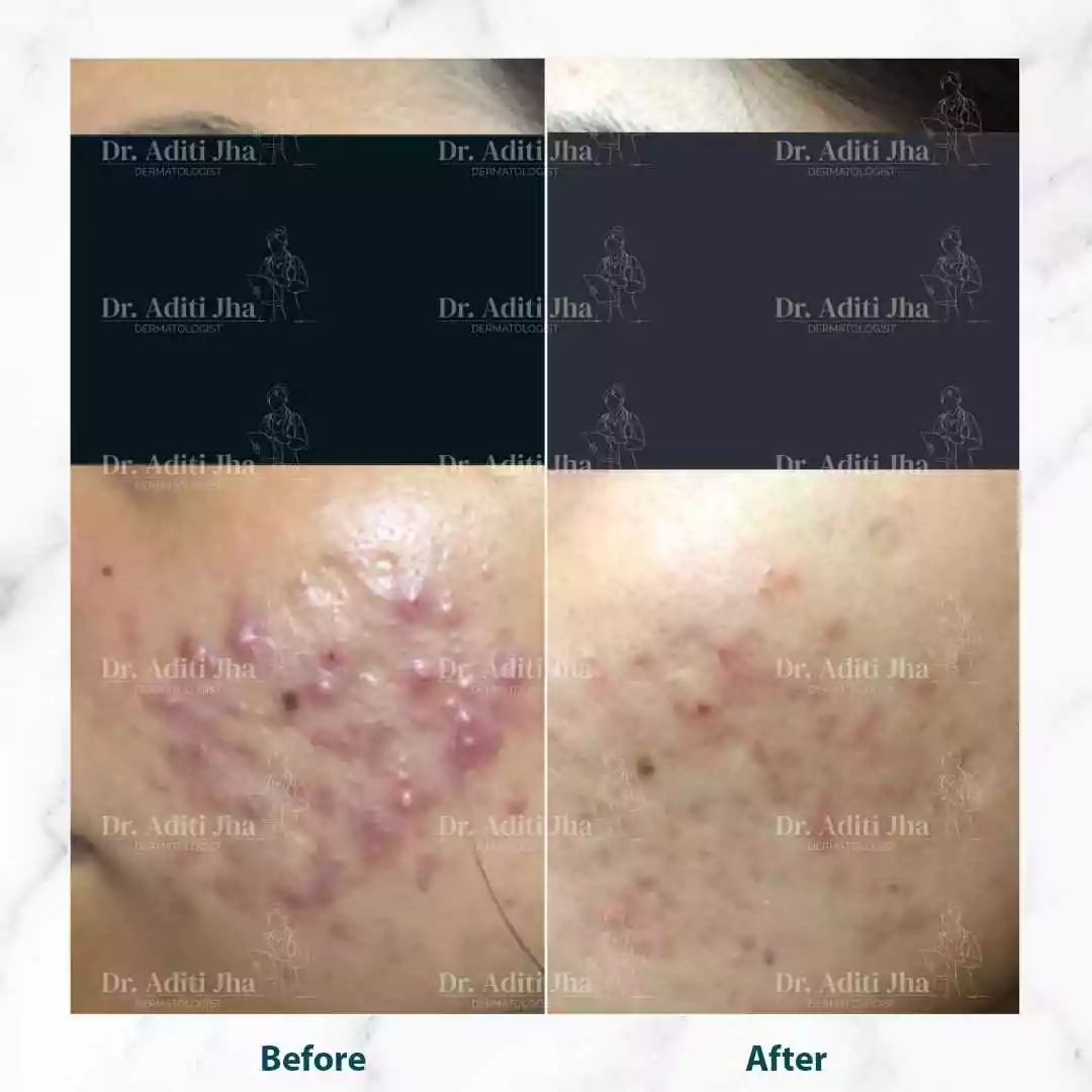 Acne (side face)