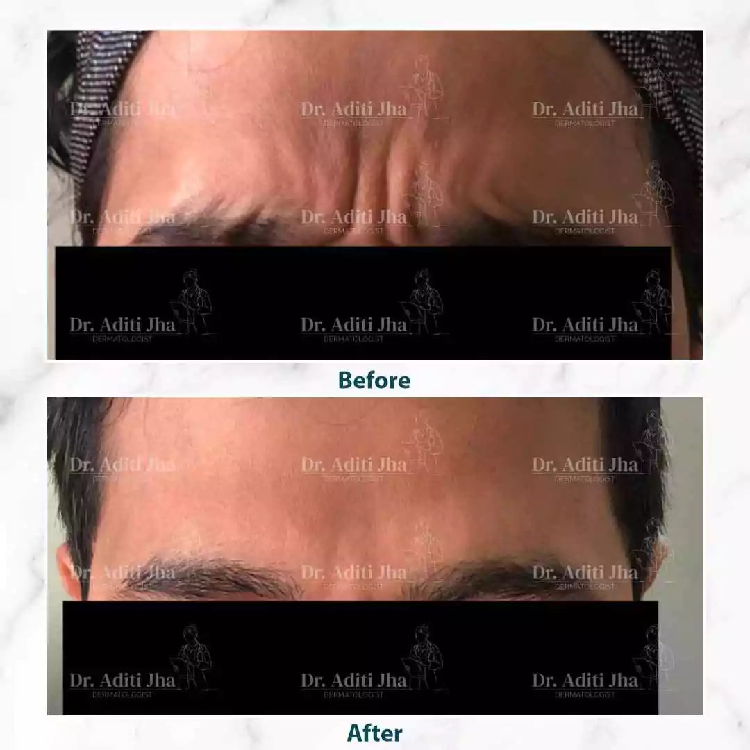 Botox (front face)