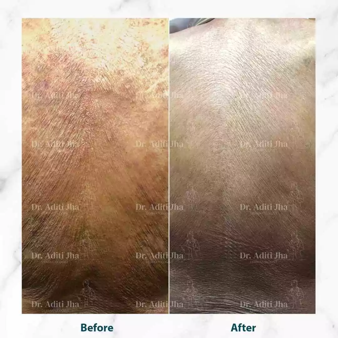 Disseminated Tinea (back)