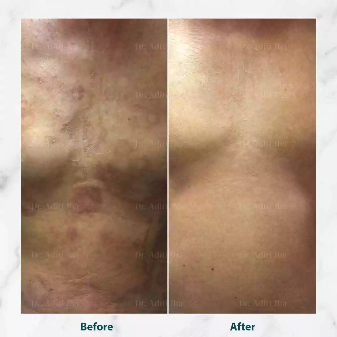 Disseminated Tinea (front)