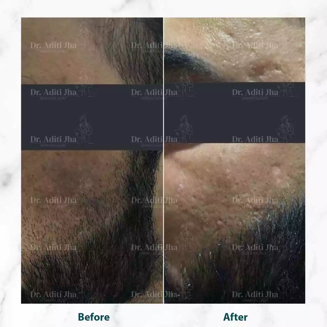 Melasma Treatment