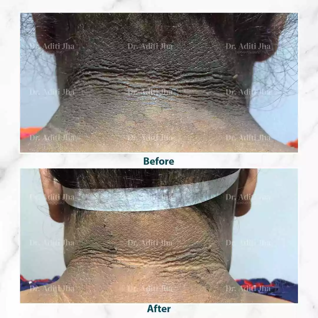 Neck Pigmentation