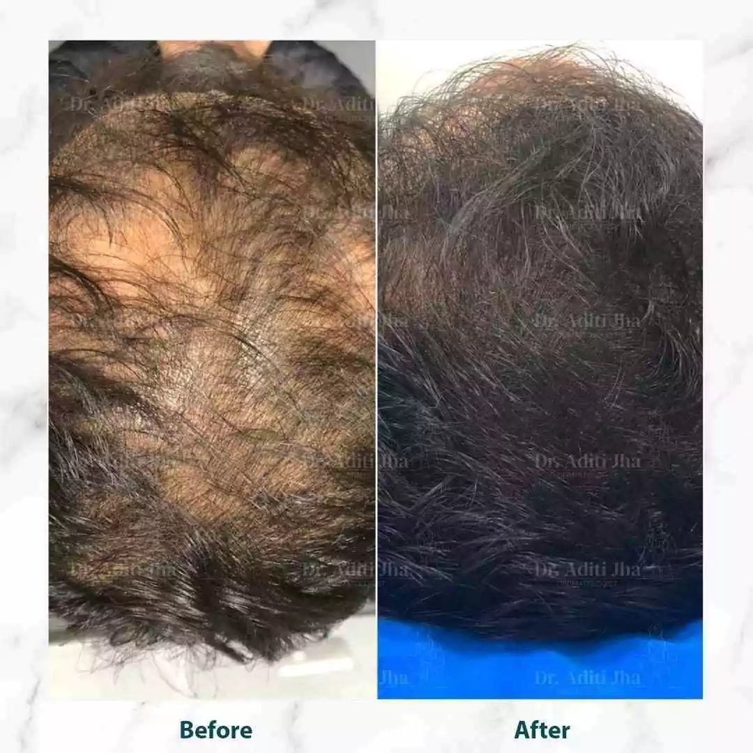 PRP Hair Loss Treatment