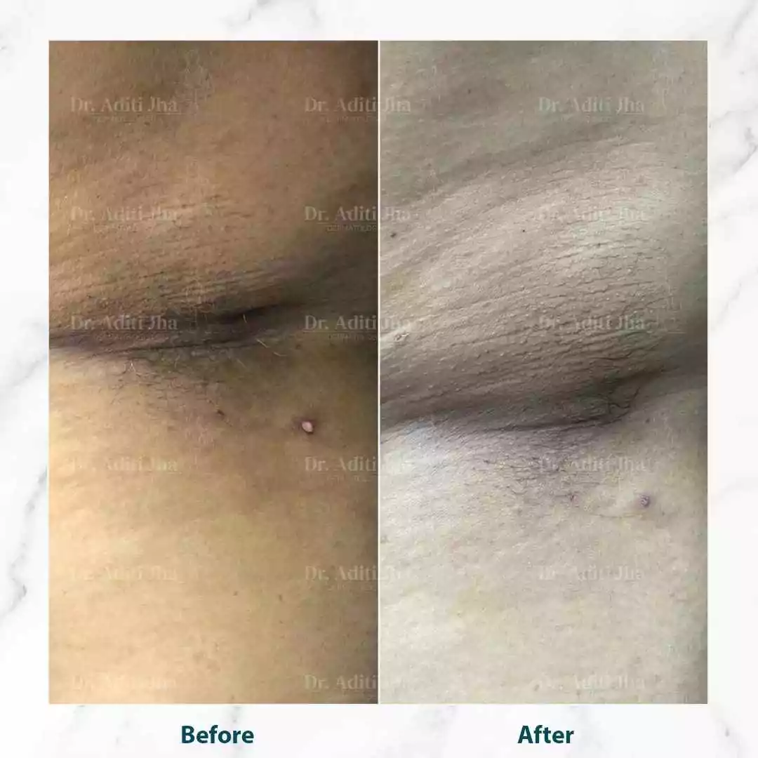 Skin tag