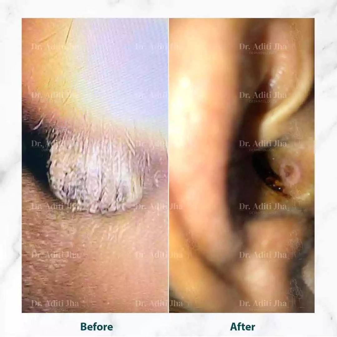 warts in ear