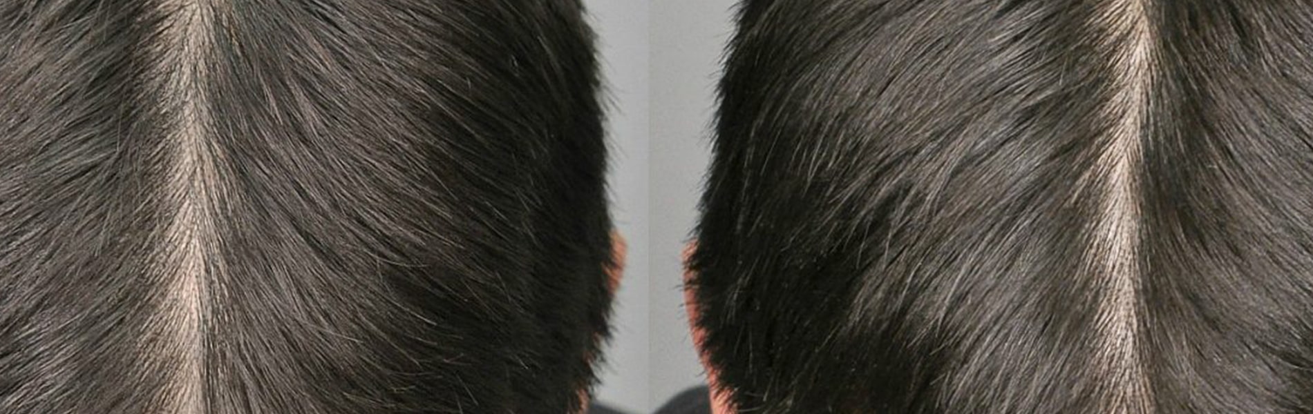 Benefits of hair fall treatment