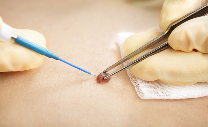 mole removal laser treatment in chandigarh