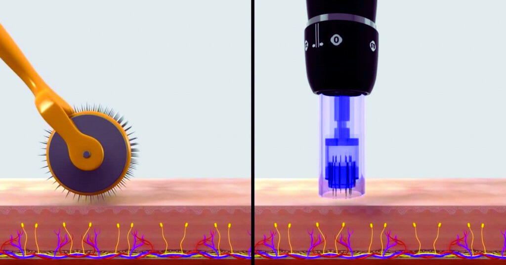 Dermarolling and Microneedling