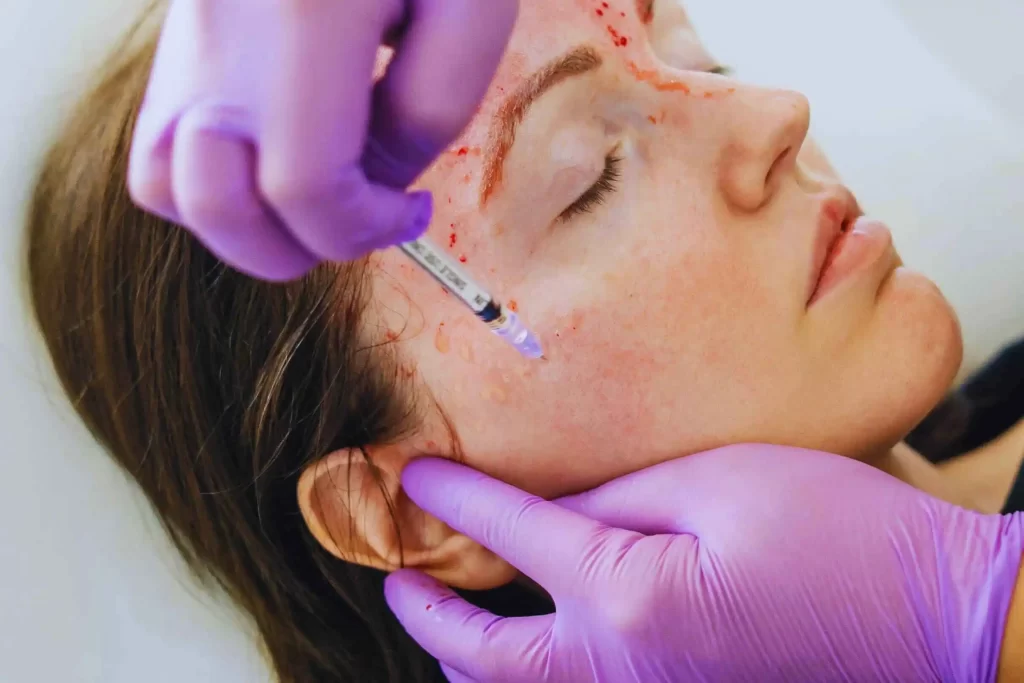 PRP Treatments