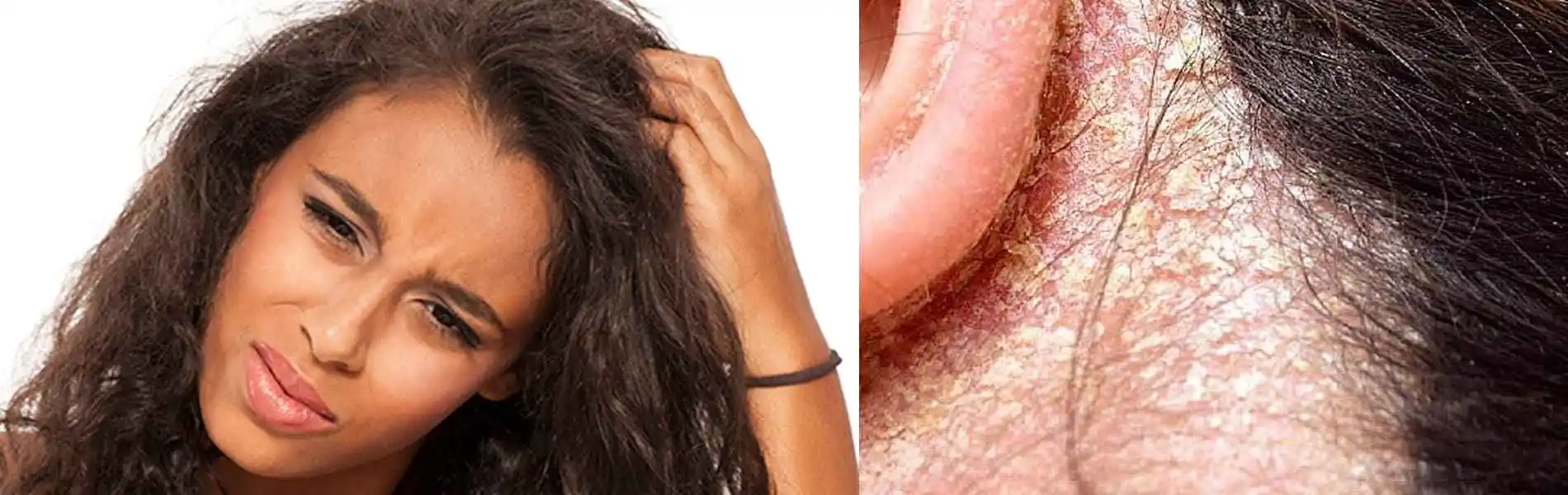 Hair and Scalp infection Treatment