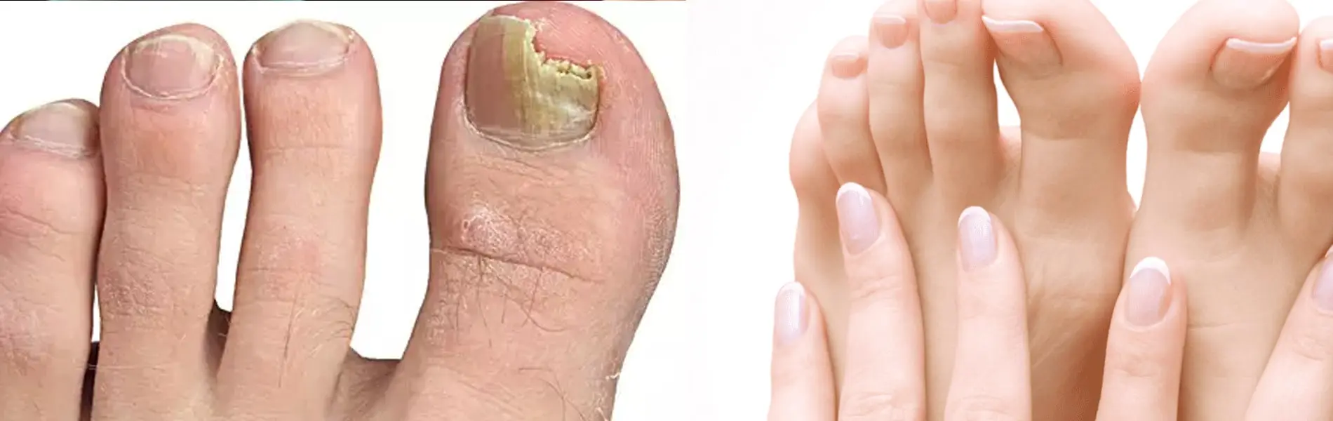 Benefits of Nail Infection Treatment
