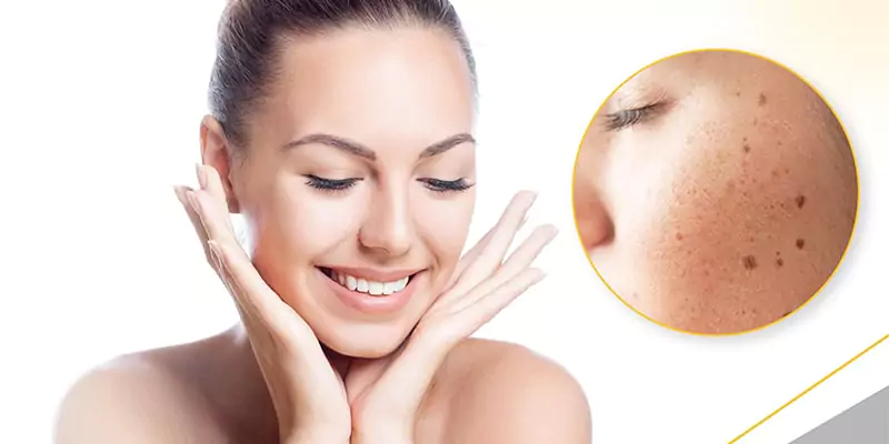 Best Pigmentation Treatment