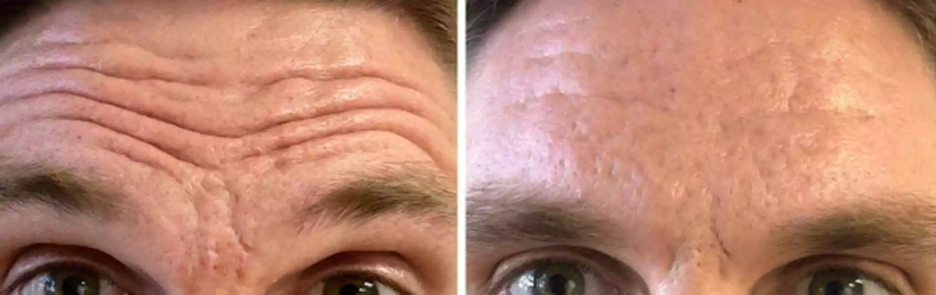 Botox Treatment Specialist in Chandigarh