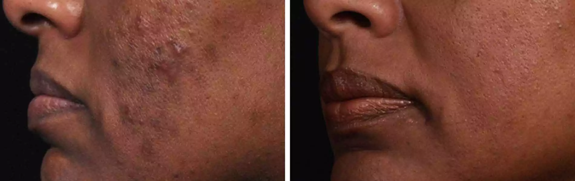 Chemical Peels in Chandigarh