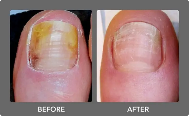 Nail Fungal Infection Treatment