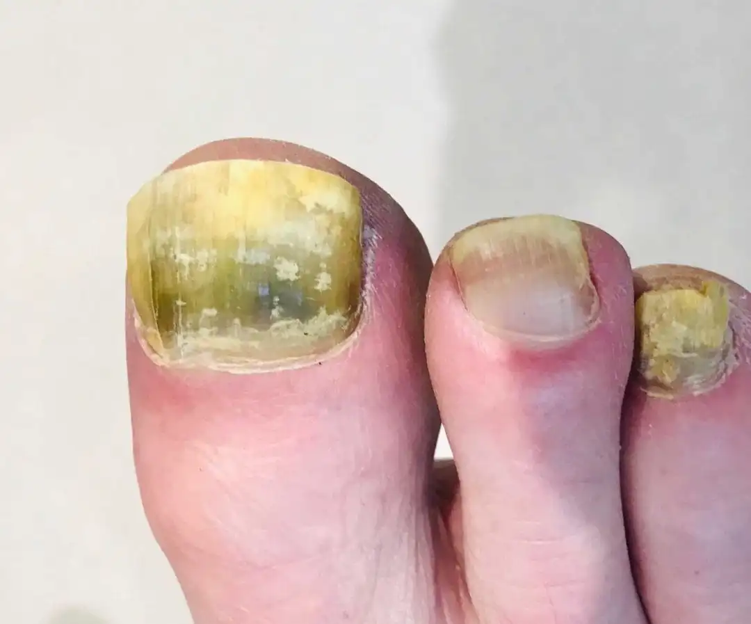 Nail Fungal Infection Treatment