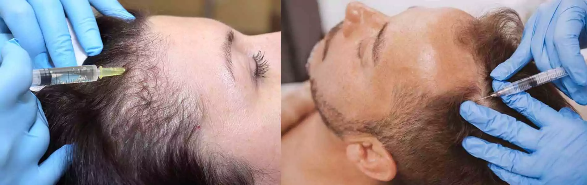 Best PRP Treatment in Chandigarh