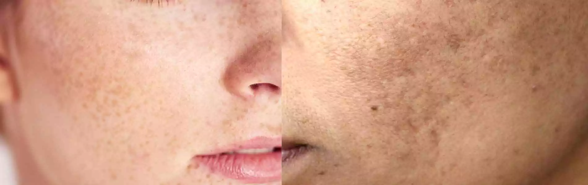 Pigmentation Treatment in Chandigarh