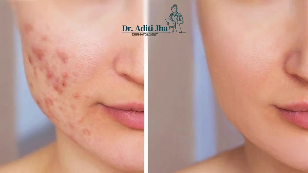 Recommended Treatments for Acne Scars
