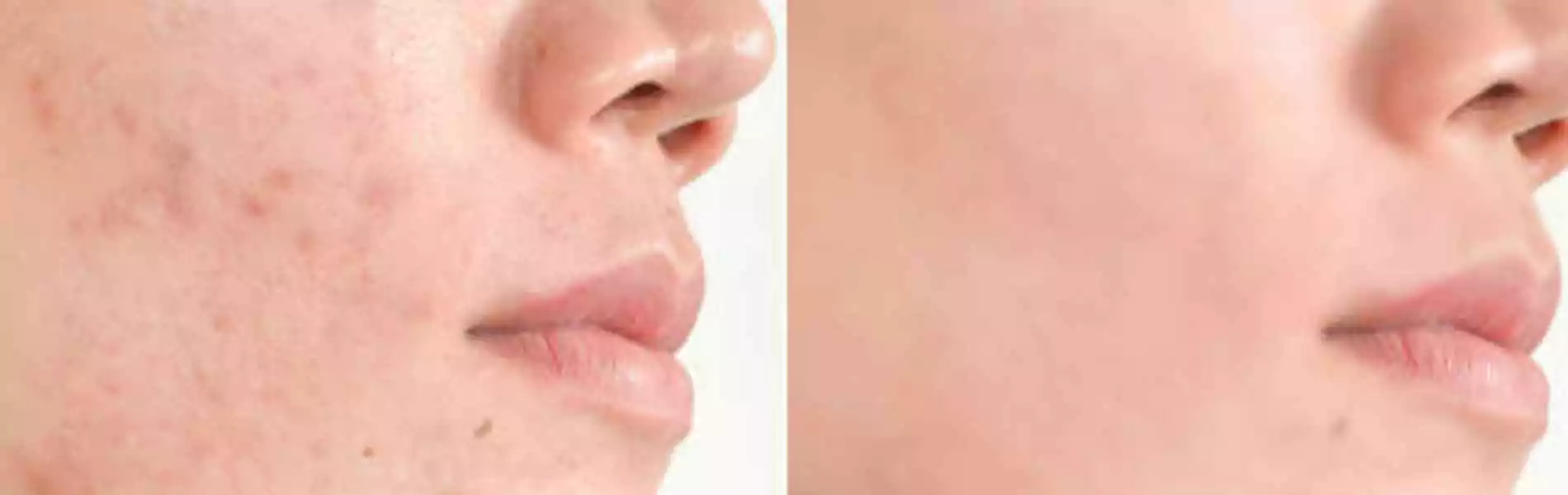 Scar removal treatment in chandigarh