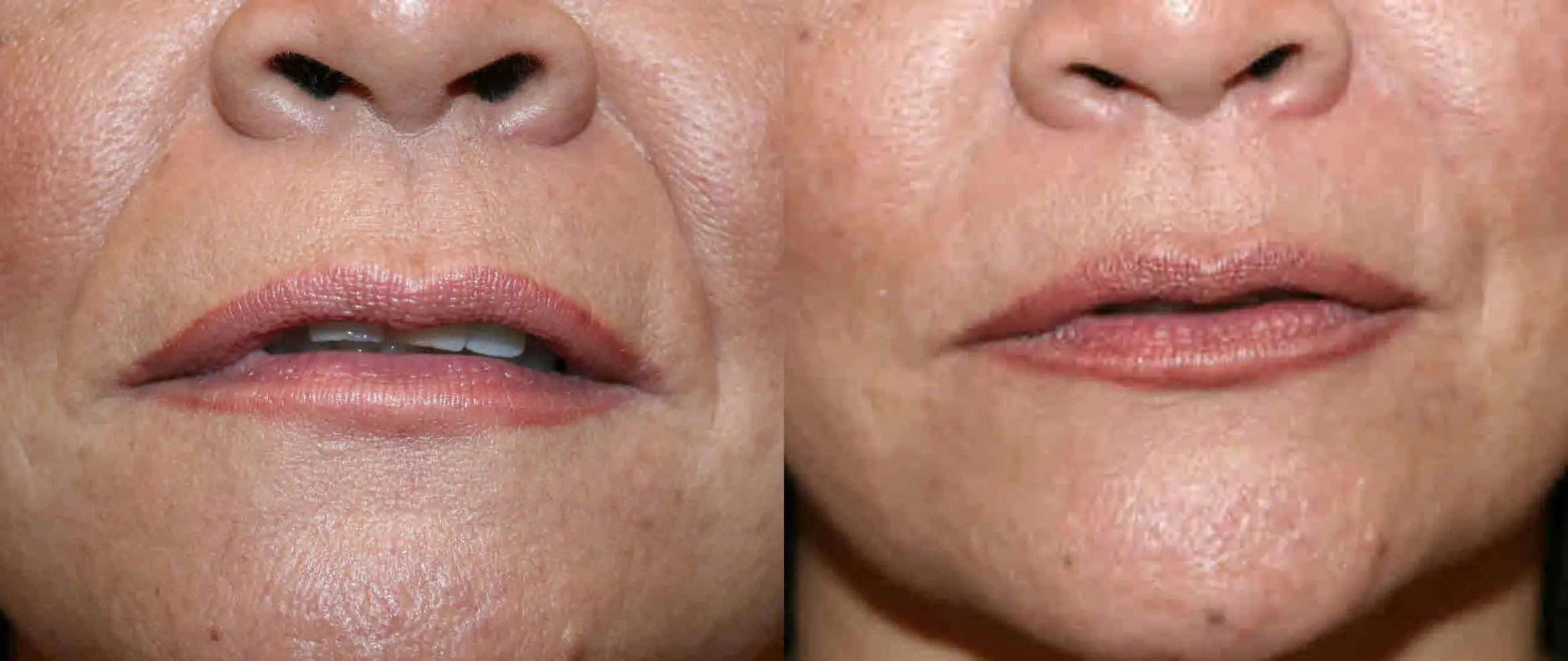 Hyaluronic Acid Fillers