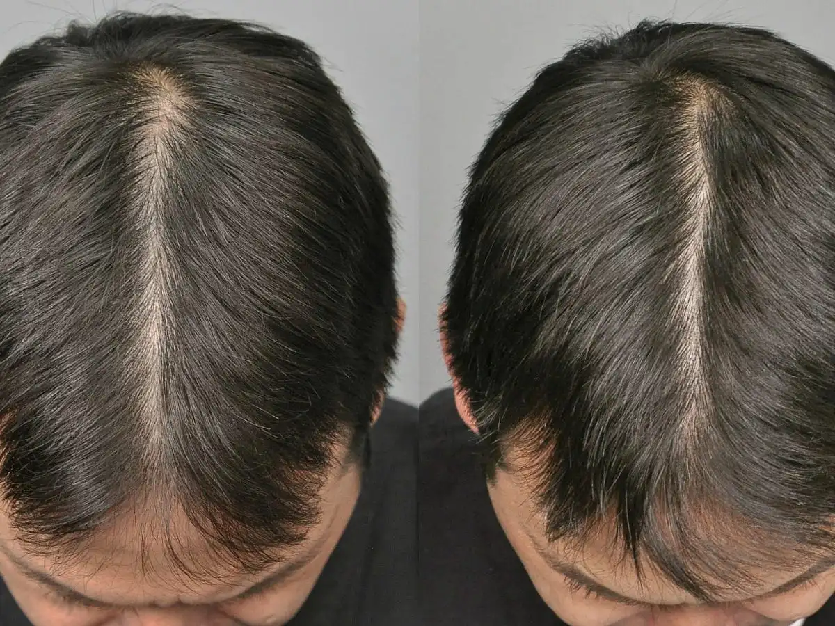 Benefits of Hair Fall Treatment