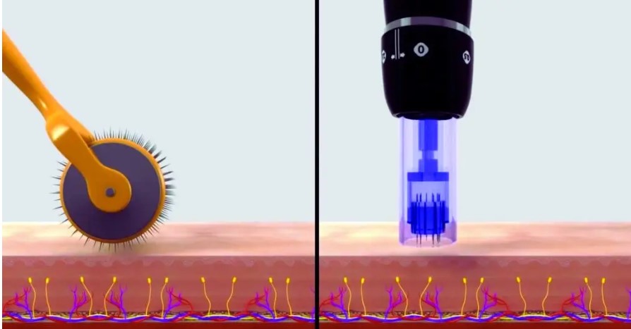 Derma Roller vs Microneedling: Understanding the Difference
